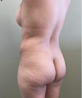 Brazilian Butt Lift Before & After Patient #1189