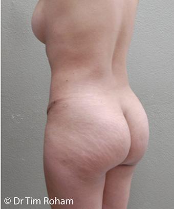 Brazilian Butt Lift Before & After Patient #1189