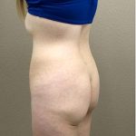Brazilian Butt Lift Before & After Patient #1190