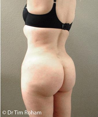 Brazilian Butt Lift Before & After Patient #1190