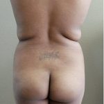Brazilian Butt Lift Before & After Patient #1191