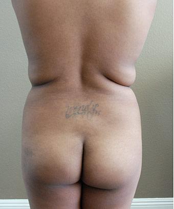 Brazilian Butt Lift Before & After Patient #1191