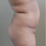 Brazilian Butt Lift Before & After Patient #1191