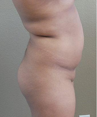 Brazilian Butt Lift Before & After Patient #1191