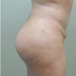 Brazilian Butt Lift Before & After Patient #1191