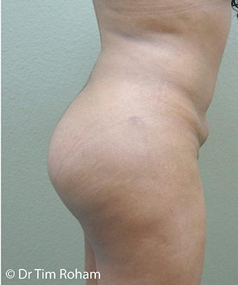 Brazilian Butt Lift Before & After Patient #1191