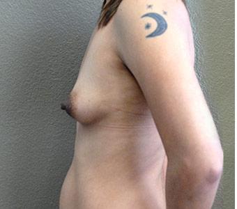 Breast Augmentation Before & After Patient #1289
