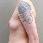 Breast Augmentation Before & After Patient #1293
