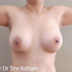 Breast Augmentation Before & After Patient #1274