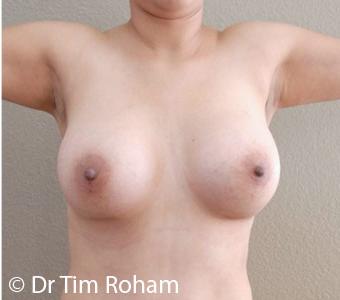 Breast Augmentation Before & After Patient #1274