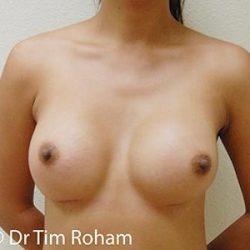 Breast Augmentation Before & After Patient #1279