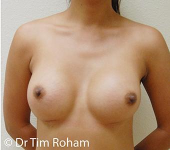 Breast Augmentation Before & After Patient #1279