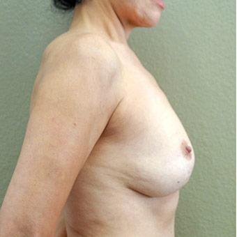 Breast Lift Before & After Patient #1319