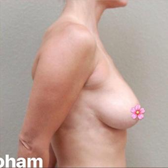 Breast Lift Before & After Patient #1322