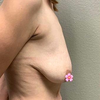 Breast Lift Before & After Patient #1324