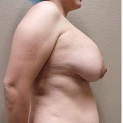 Breast Lift Before & After Patient #1325