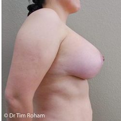 Breast Lift Before & After Patient #1325