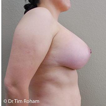 Breast Lift Before & After Patient #1325