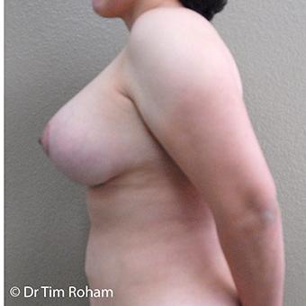 Breast Lift Before & After Patient #1325