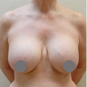 Breast Reduction Before & After Patient #1557