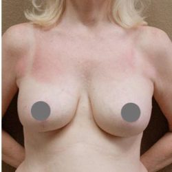 Breast Reduction Before & After Patient #1557