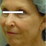 Chemical Peels Before & After Patient #1413