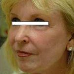 Chemical Peels Before & After Patient #1413