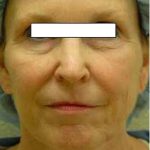 Chemical Peels Before & After Patient #1413