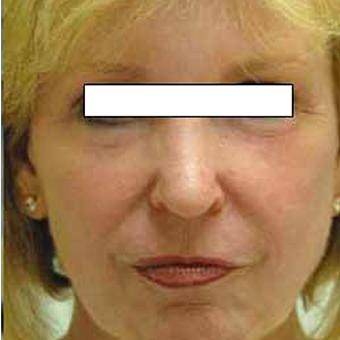Chemical Peels Before & After Patient #1413
