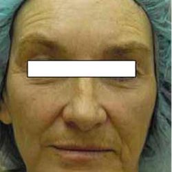 Chemical Peels Before & After Patient #1414