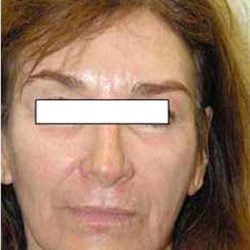 Chemical Peels Before & After Patient #1414