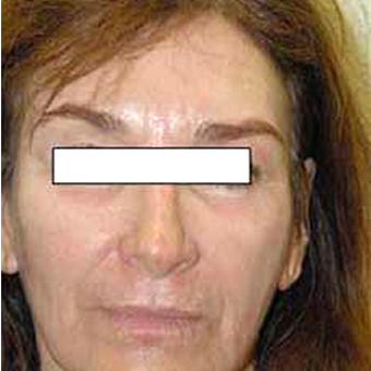 Chemical Peels Before & After Patient #1414