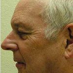 Chemical Peels Before & After Patient #1415