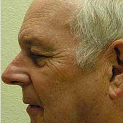 Chemical Peels Before & After Patient #1415