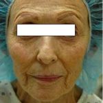 CO2 Skin Resurfacing Before & After Patient #1416
