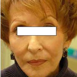 CO2 Skin Resurfacing Before & After Patient #1416