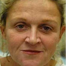 CO2 Skin Resurfacing Before & After Patient #1417