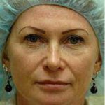 CO2 Skin Resurfacing Before & After Patient #1418