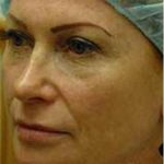 CO2 Skin Resurfacing Before & After Patient #1418