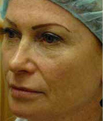 CO2 Skin Resurfacing Before & After Patient #1418