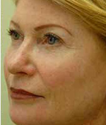 CO2 Skin Resurfacing Before & After Patient #1418