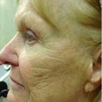 CO2 Skin Resurfacing Before & After Patient #1420