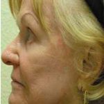 CO2 Skin Resurfacing Before & After Patient #1420
