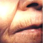 CO2 Skin Resurfacing Before & After Patient #1421