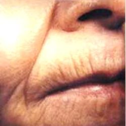 CO2 Skin Resurfacing Before & After Patient #1421