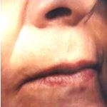 CO2 Skin Resurfacing Before & After Patient #1421