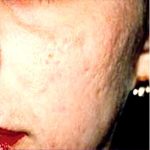 CO2 Skin Resurfacing Before & After Patient #1422