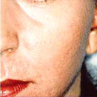CO2 Skin Resurfacing Before & After Patient #1422