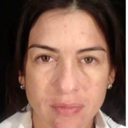 Cosmelan Before & After Patient #1512