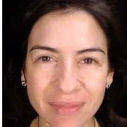 Cosmelan Before & After Patient #1512